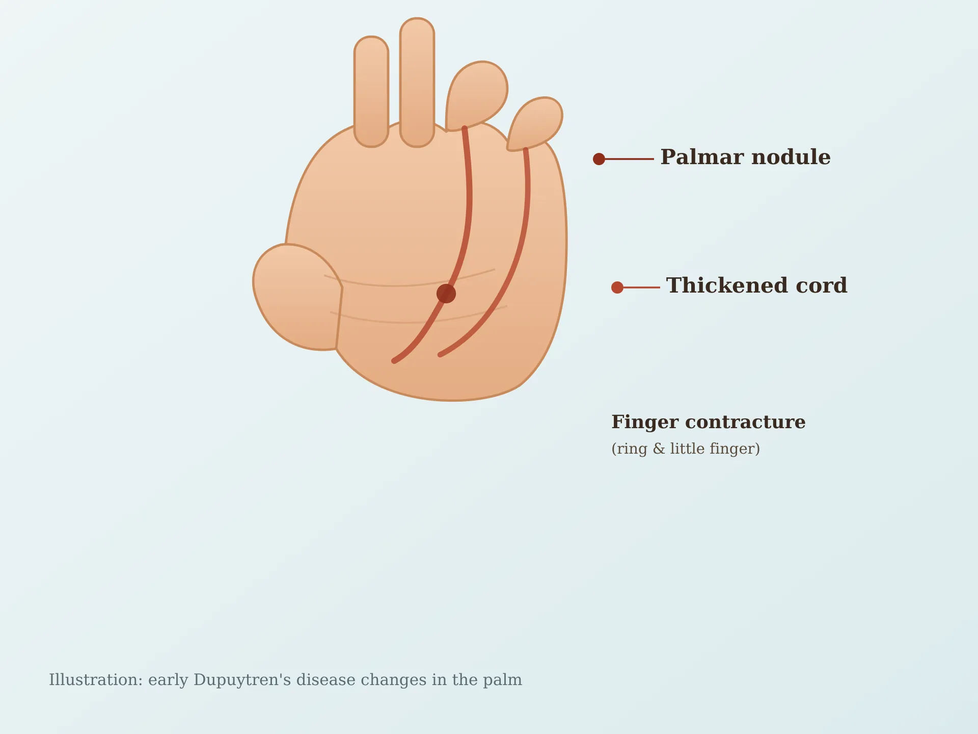 Dupuytren’s Diathesis: Causes, Symptoms, Risk Factors, and Treatment Options